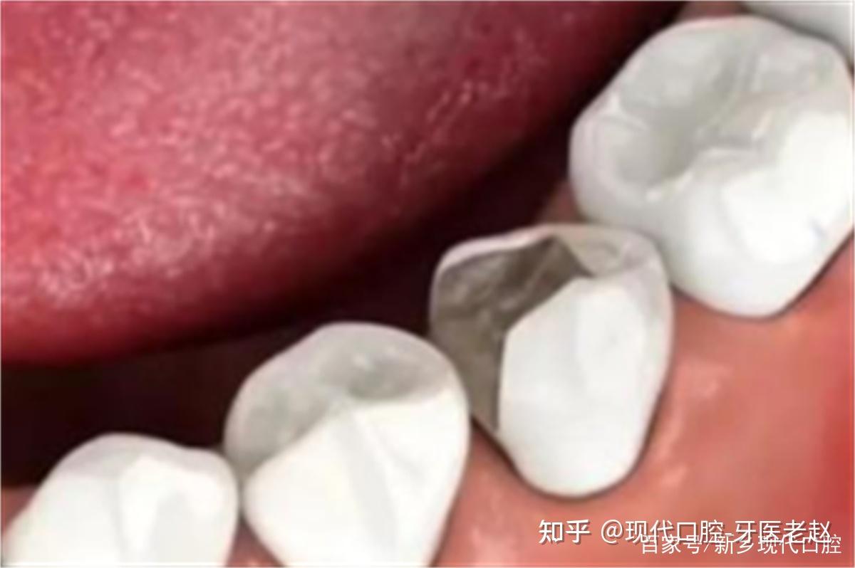 残冠,残根要不要拔除 - 知乎