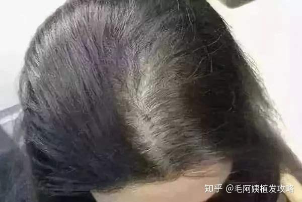 我是女生頭頂發縫越來越寬這是女性雄禿嗎