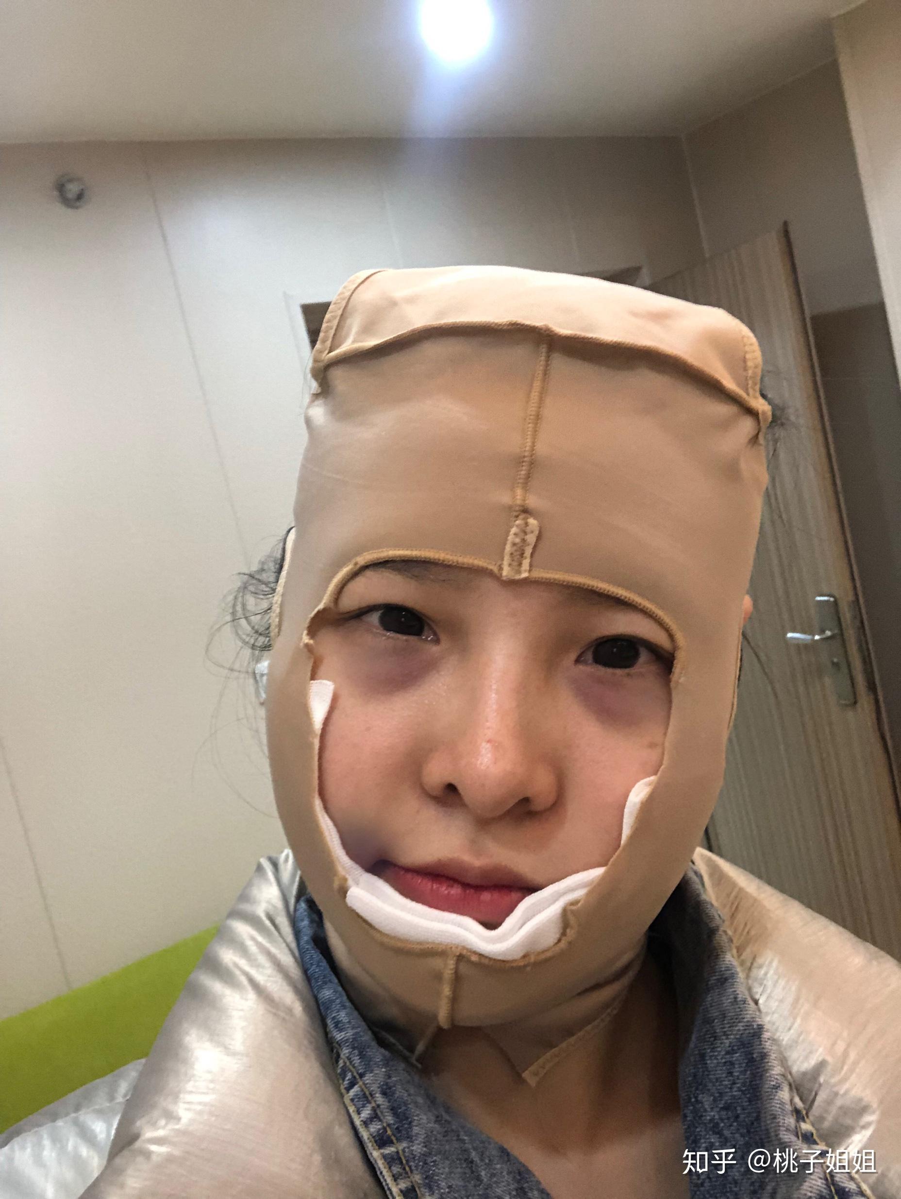 成都下颌角手术,术后半年恢复记录 - 知乎