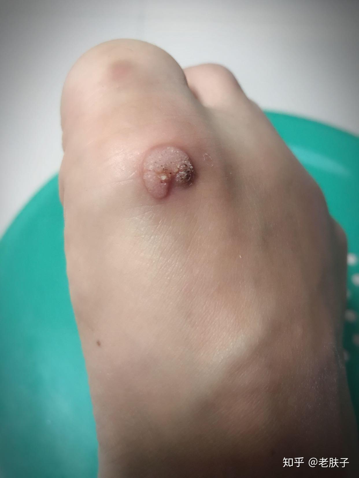 刺瘊怎么办 - 知乎