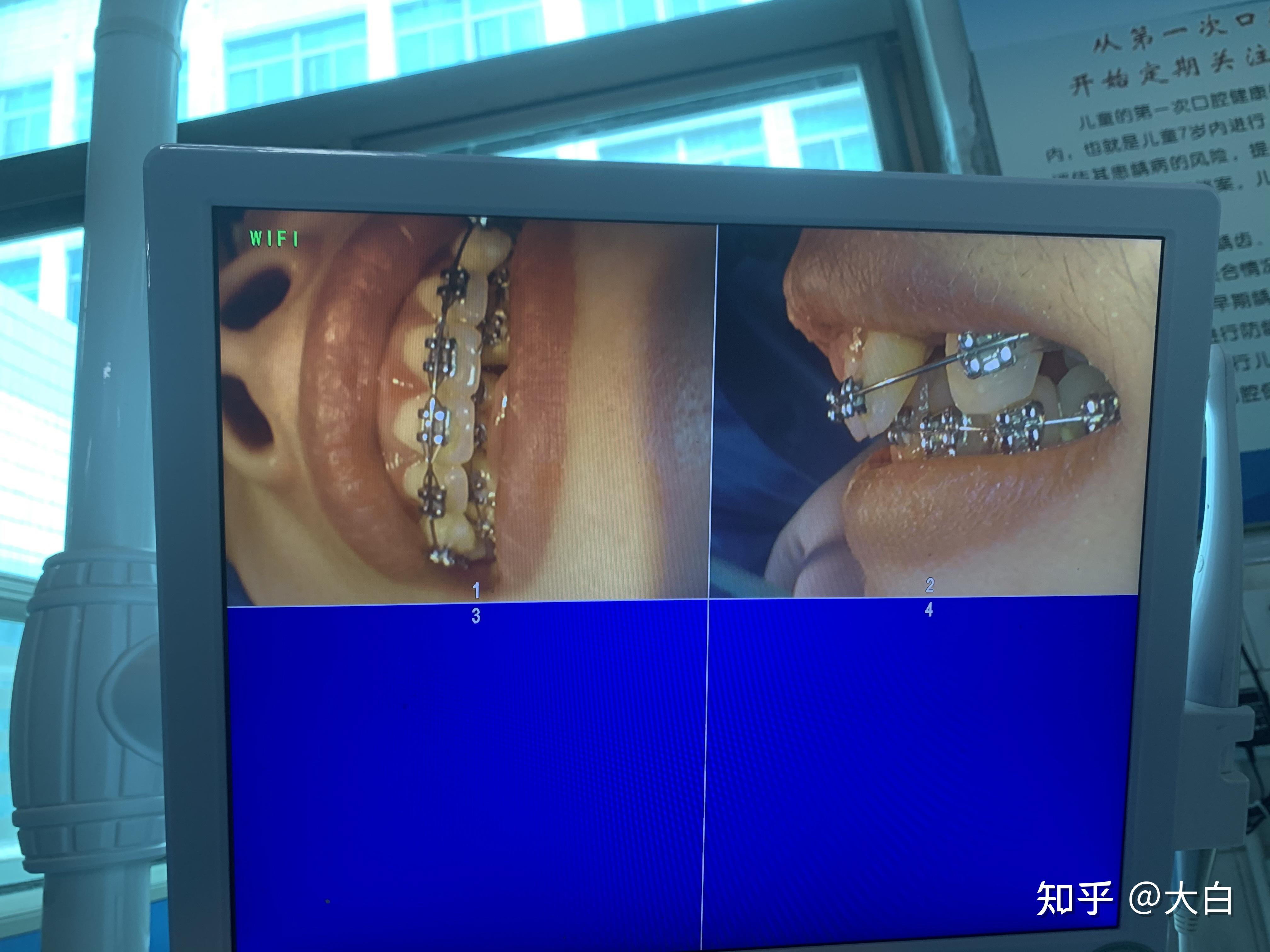 30歲終於下定決心整牙記錄一下