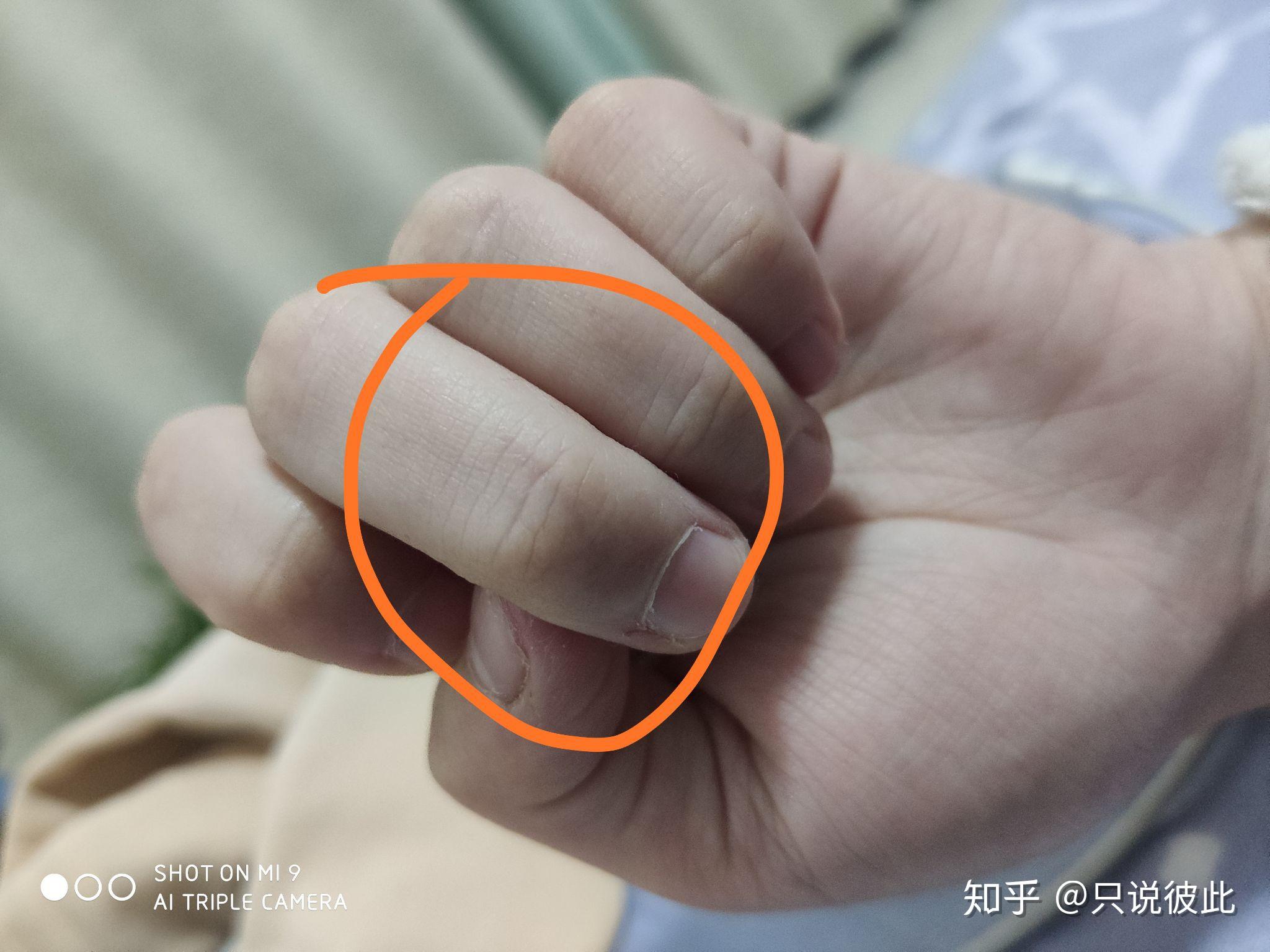 被狗狗牙划了一下.在纠结要不要打针 - 知乎