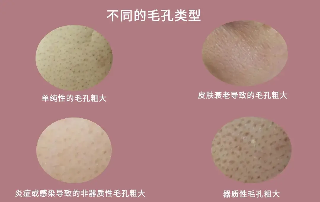 性的毛孔粗大这类型毛孔粗大是因为油脂分泌旺盛堵塞毛孔而形成角栓