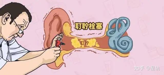 唐山五官医院耵聍栓塞是什么耵聍栓塞有哪些危害