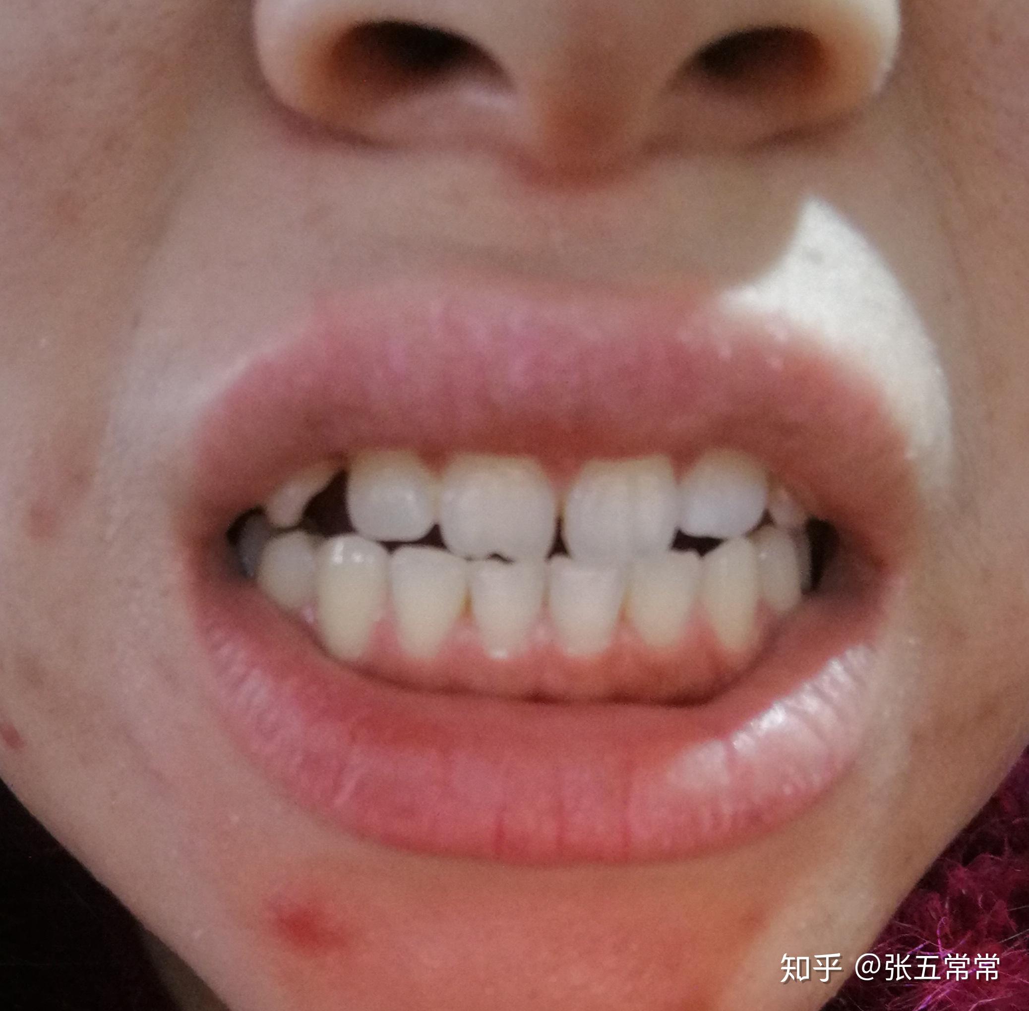 修复案例：上颌2颗门牙做了「冠延长术」+修复8颗「全瓷贴面」 - 知乎