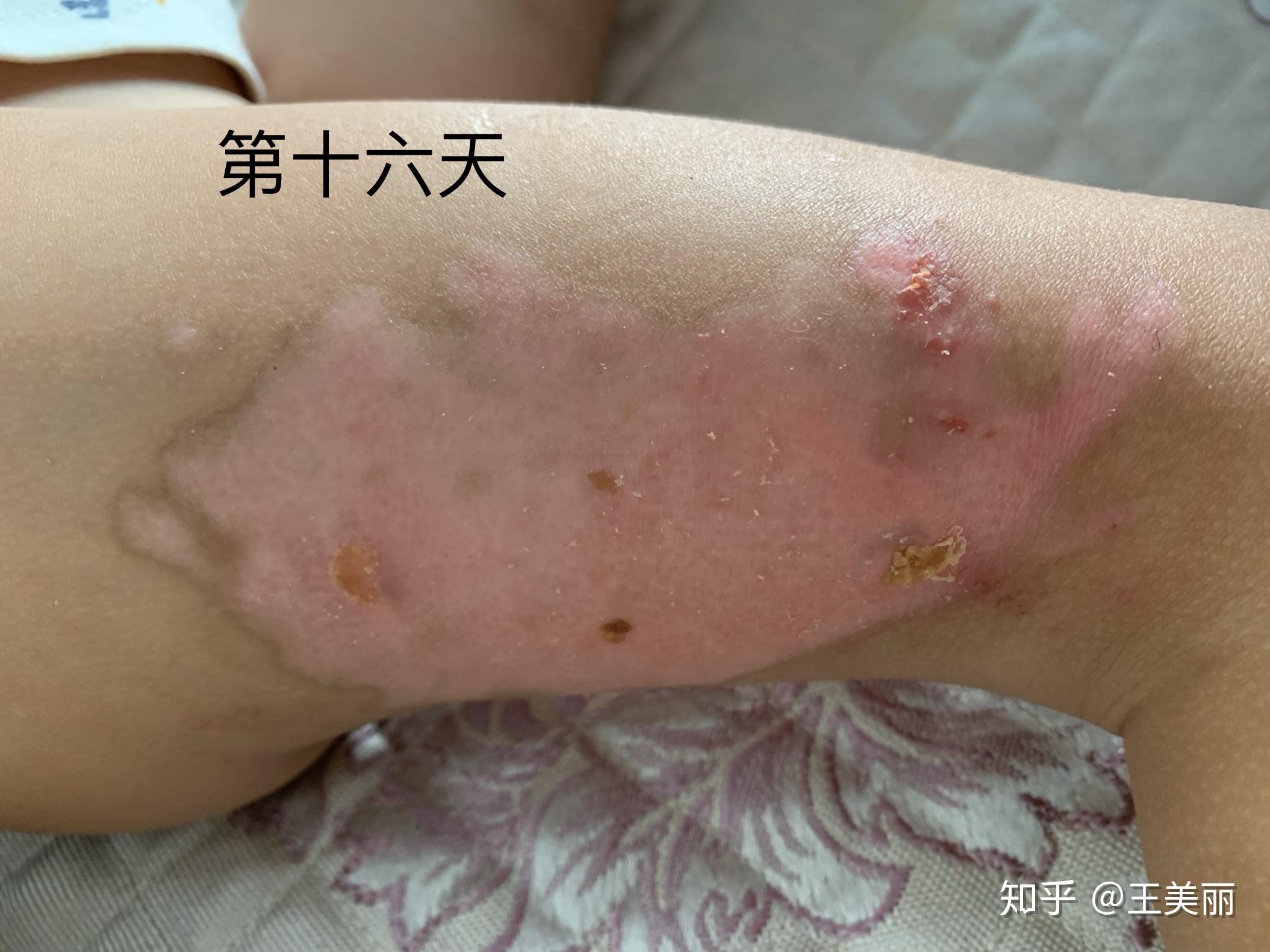 纪录两岁半宝宝开水烫伤恢复过程
