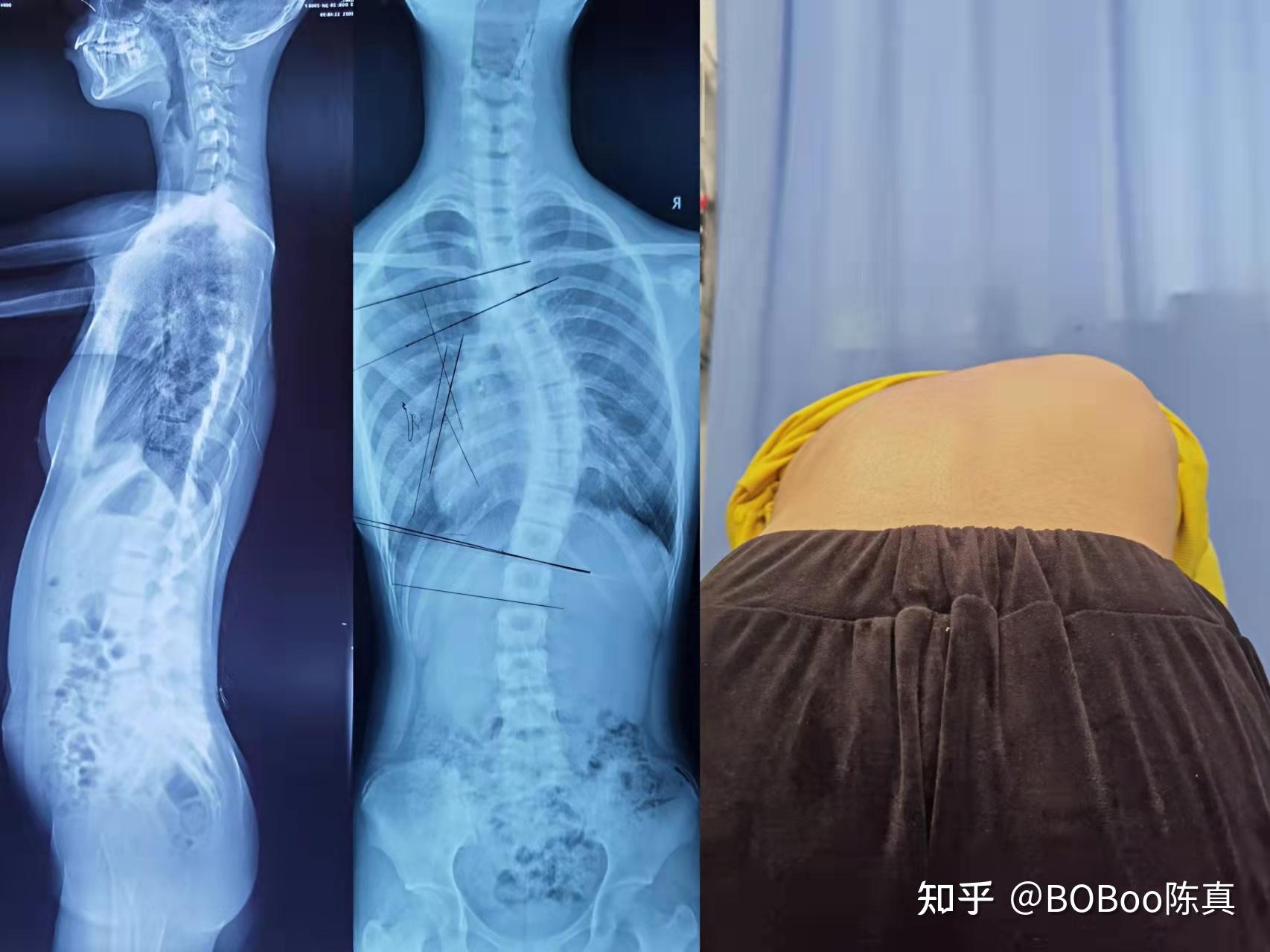 脊柱侧弯吊单杠真的有用吗? - 知乎