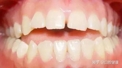 孩子门牙连面条都咬不断，『开颌』的人生到底有多惨？ - 知乎
