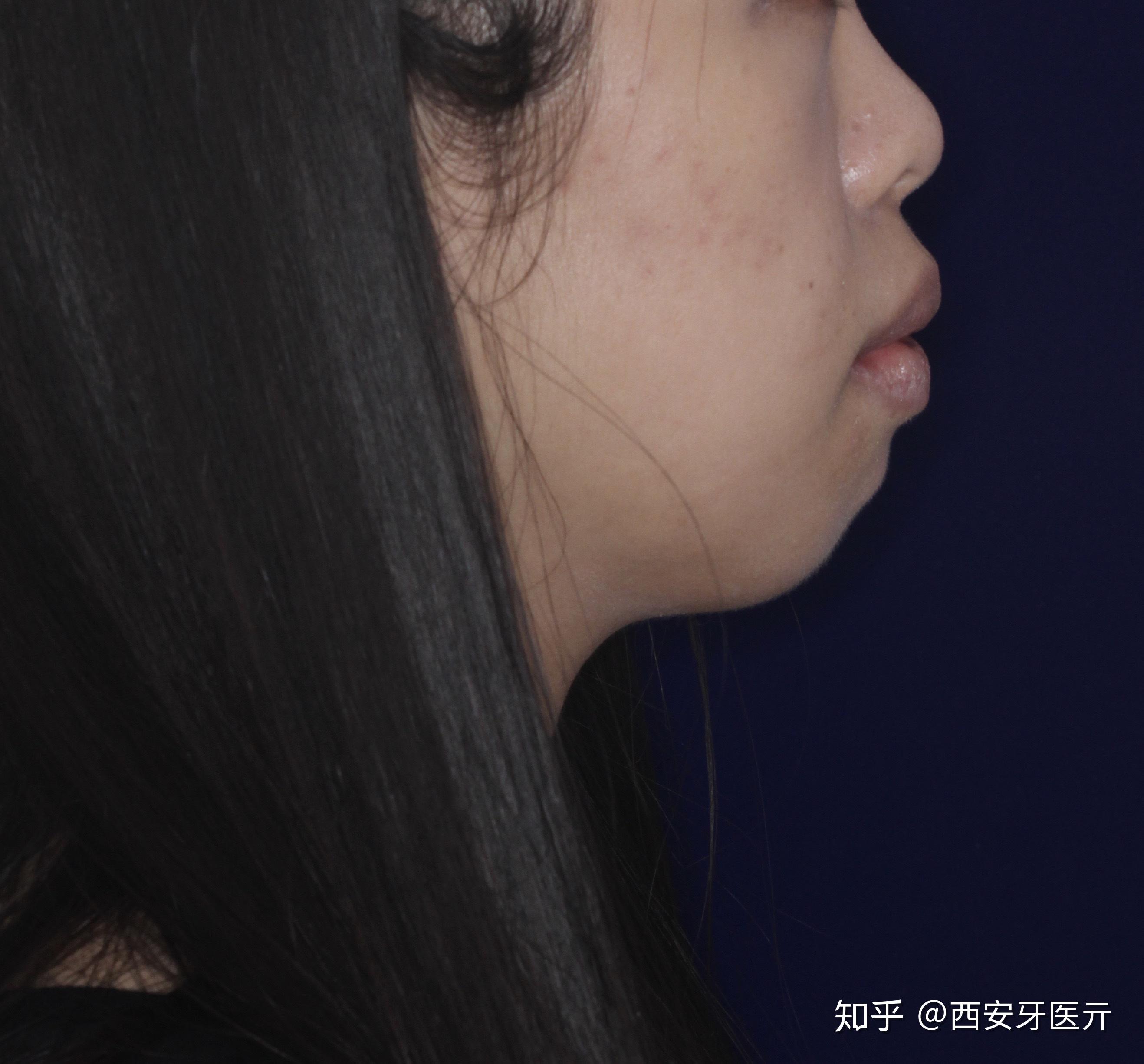 双颌前突的正畸治疗牙齿矫正变脸记