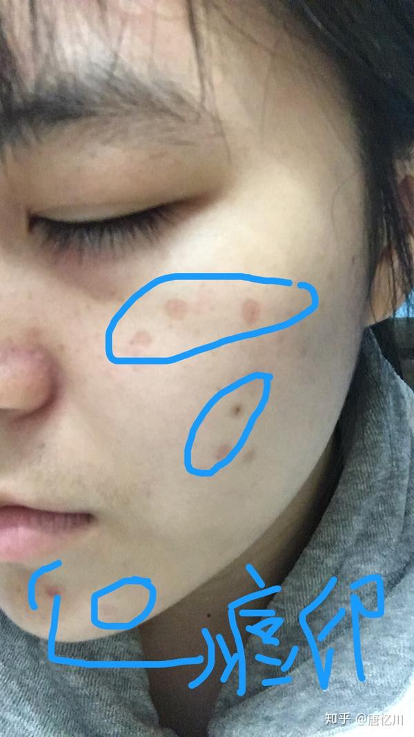 激光点痣多图辣眼