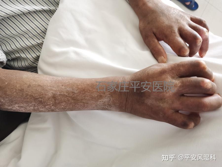 表情僵硬笑容消失这种病让人历经石化之痛