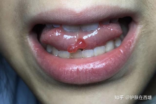 外伤性粘液囊肿:通常是由于口腔内的轻微损伤造成的,如牙齿不听使唤