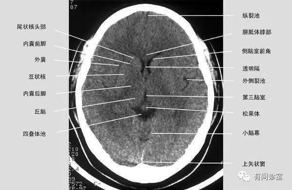 一种重要病因)癫痫通常不采用ct检查,因为ct上大脑的结构看的并不清楚