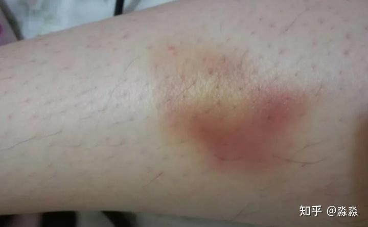 的红细胞当皮肤下的伤口开始愈合时血红细胞因为缺氧逐渐呈现出紫红