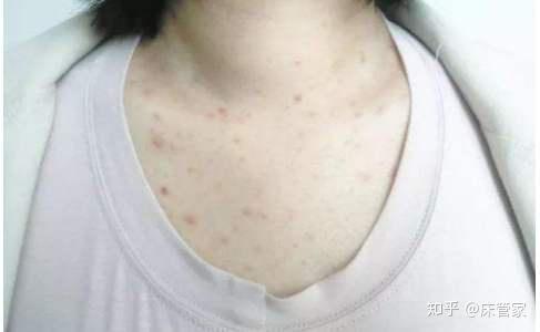 螨虫过敏有哪些症状?