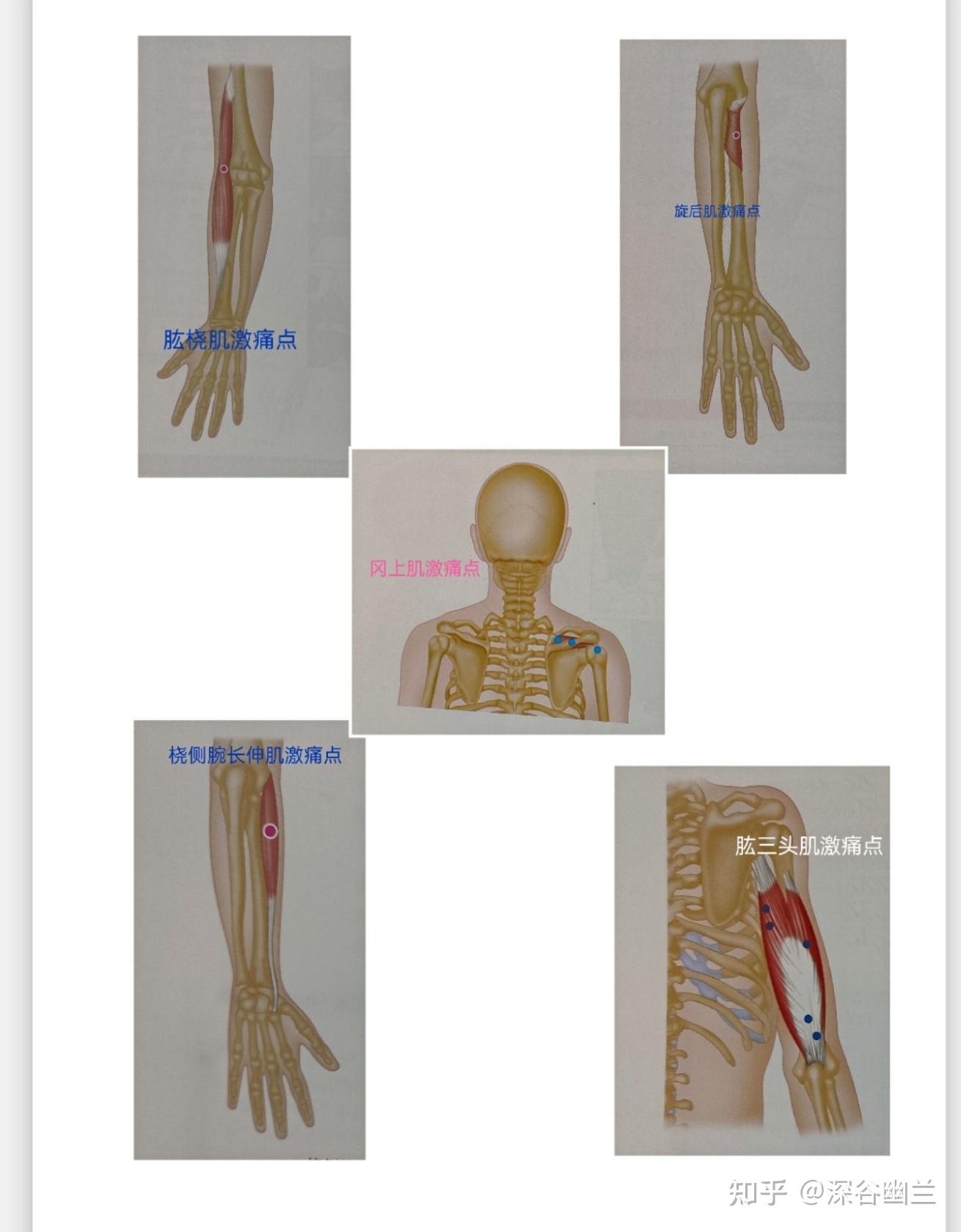 肱桡肌激痛点牵涉痛是肱骨外上髁附近3～4厘米有些微手臂疼痛,在拇指