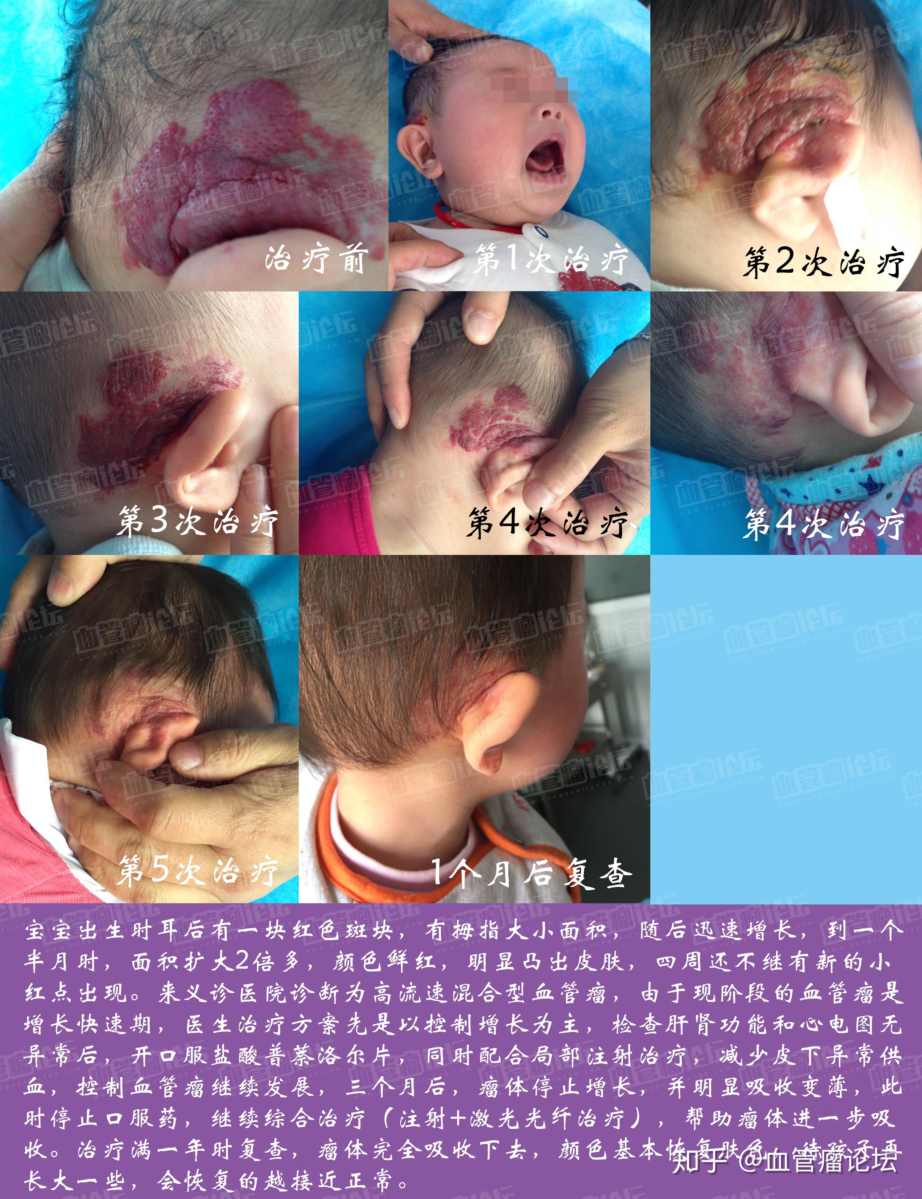 宝宝耳后出现大面积血管瘤
