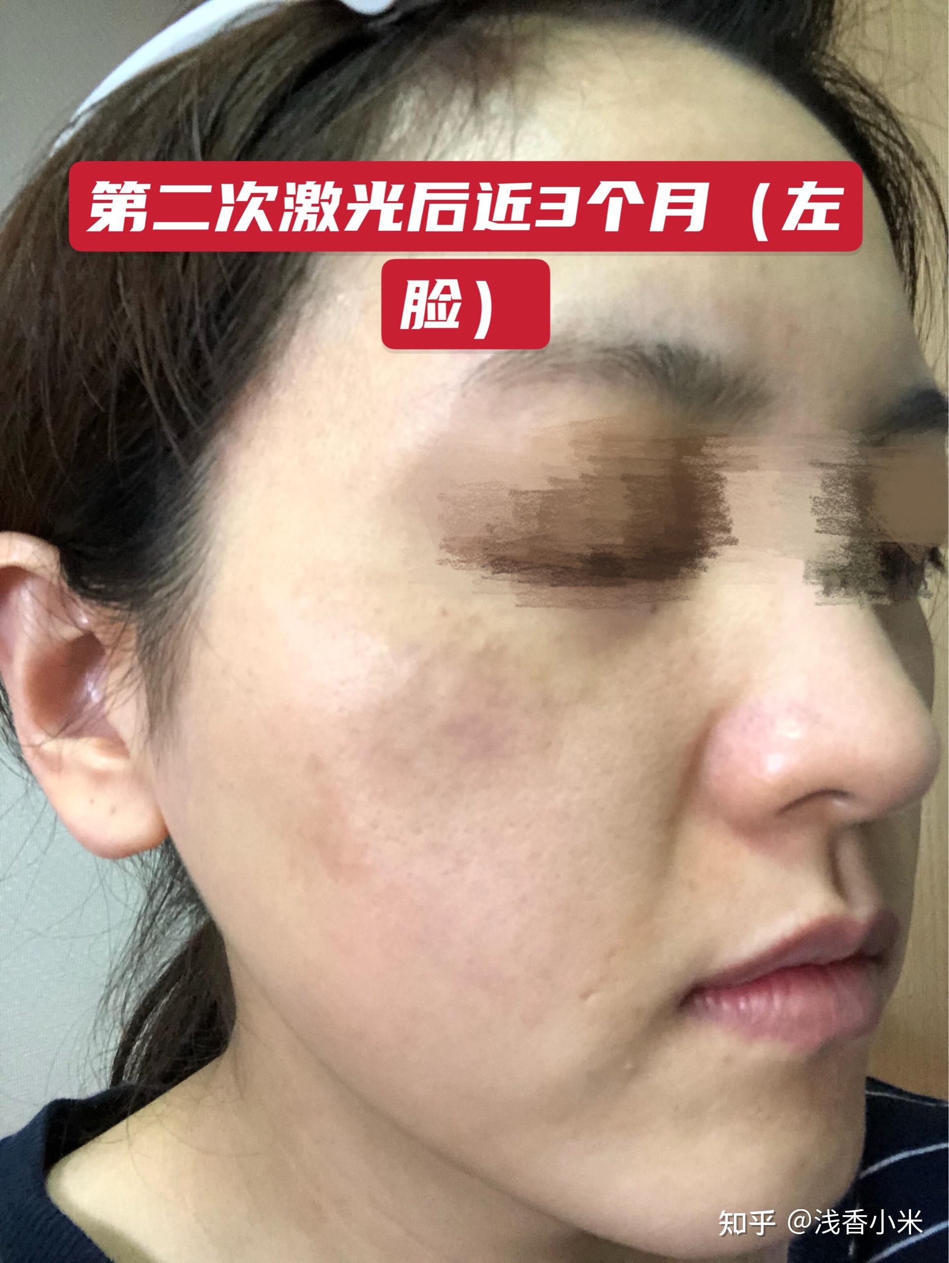 日记：我在日本的皮肤诊所做了调Q红宝石激光祛真皮斑（ADM）（持续更新中） - 知乎