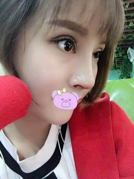 【真人案例】猪鼻子做鼻综合直接变成韩佳人同款小翘鼻