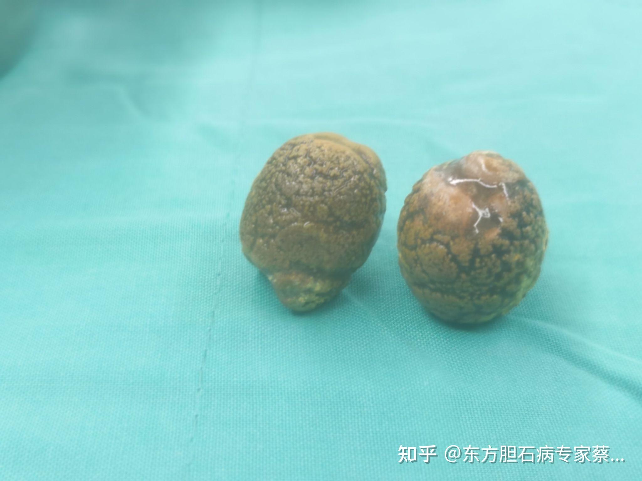 你想像胆囊内结石的样子和结石取出后的样子有什么不同