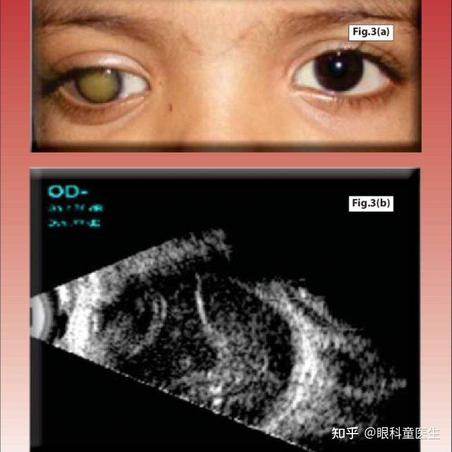 视网膜母细胞瘤超声图片