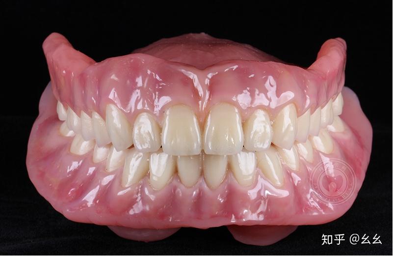 活动义齿修复类产品也能满足你对美的追求