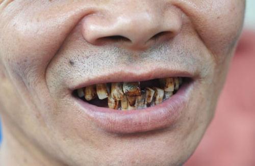 致美口腔介绍氟斑牙有哪些危害