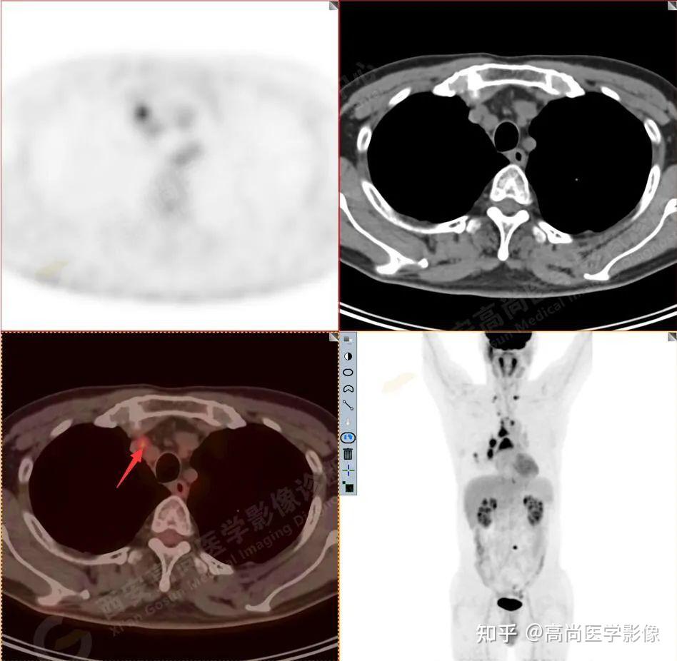 PET/CT肿瘤分期：低分化肺腺癌，小结节大转移两例【高尚医学影像】 - 知乎