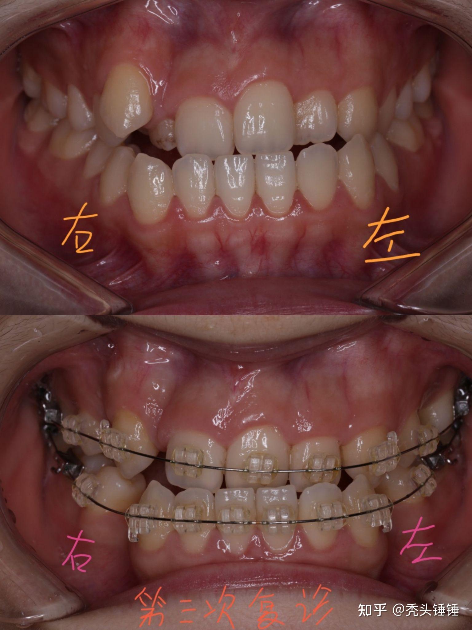 牙齿骨性反颌矫正 记录给自己