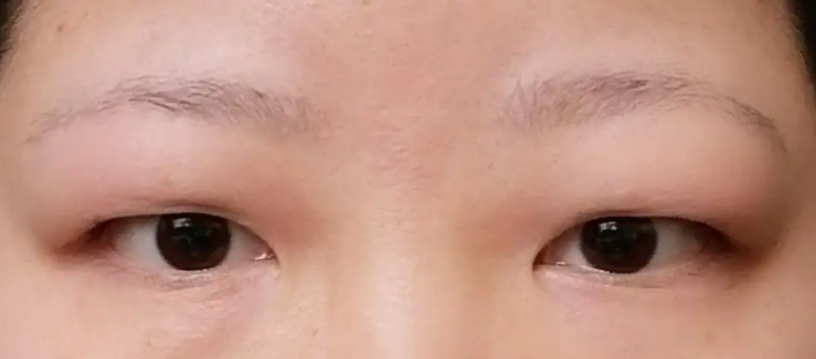 肿泡眼表现为上眼皮饱满,臃肿,严重者眼皮下垂形成三角眼,不仅影响