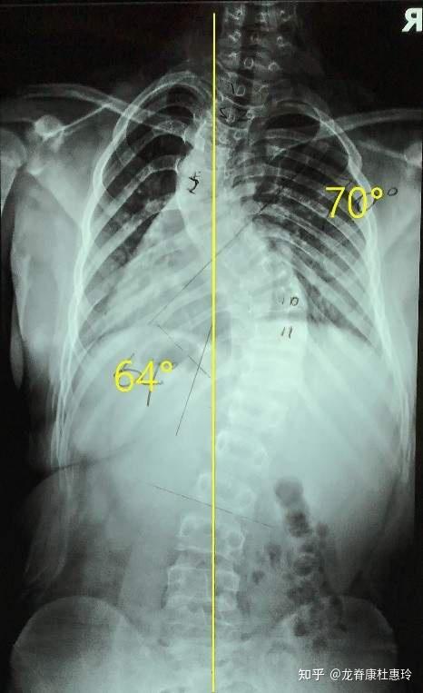 地区所说的60°,部分椎体出现楔形改变,而且二维平面上看胸廓也有变形
