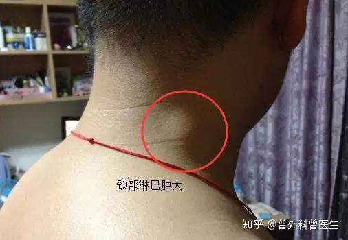 我们的身体里面,有很多浅表的淋巴结,如果你在锁骨上,腋窝,腹股沟