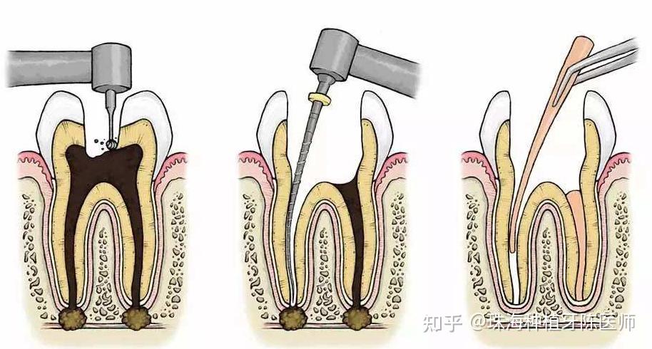 根尖周炎的治疗方法图片