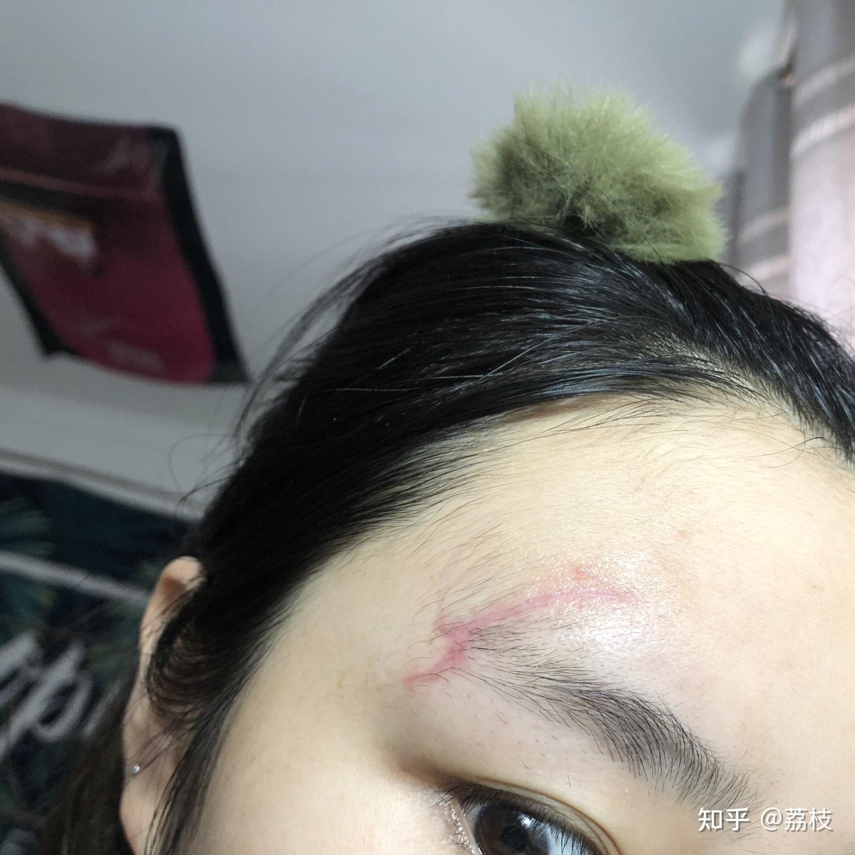 用什么可以淡化疤痕