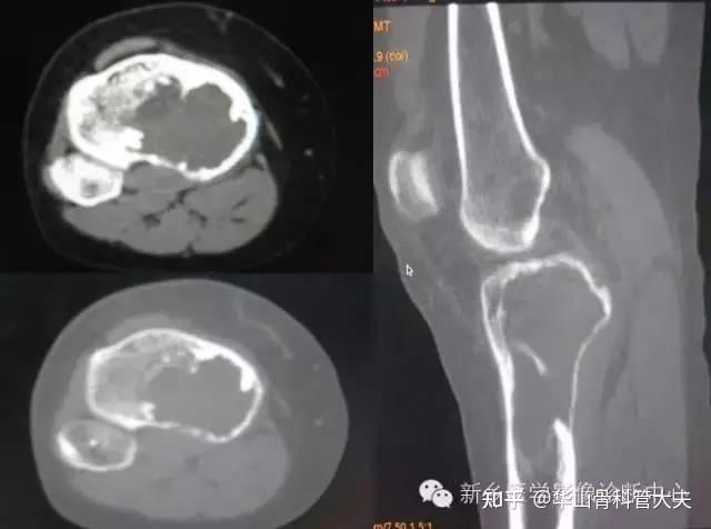 骨科影像学检查的放大镜——CT扫描 - 知乎