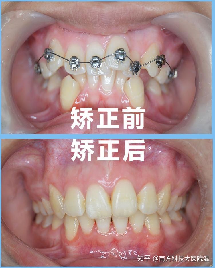 浅析牙齿矫正的方法及适应症