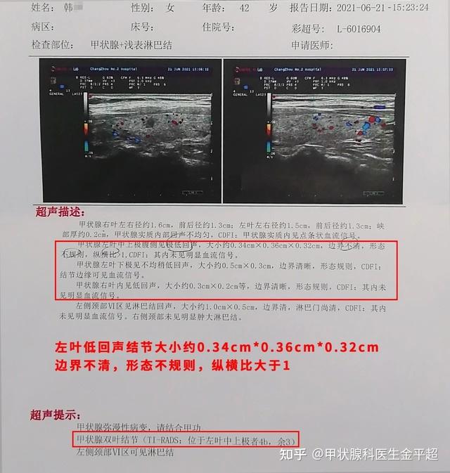 43歲女子體檢查出甲狀腺結節4c類還有繼續觀察下去的必要嗎