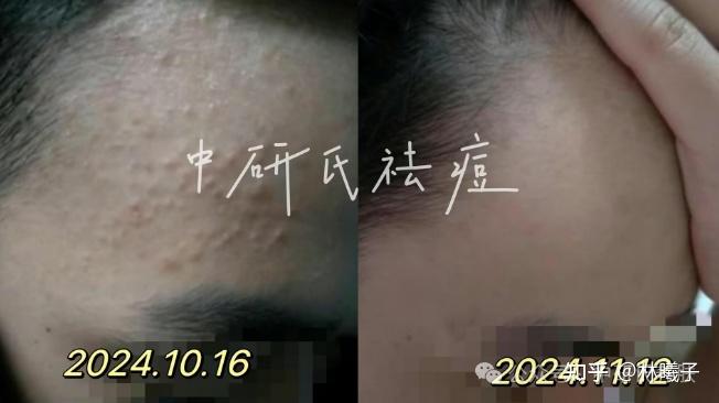 爆痘警告!别再针清闭口粉刺了,闭口不挤一样会能消掉! - 知乎