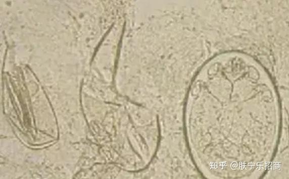 教你走出误区——疥疮小科普 - 知乎