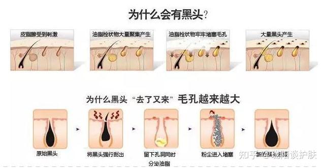 黑头是怎么形成的?为什么总是挤了又长?怎么消除? - 知乎