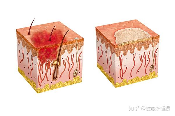 伤口结痂了但是周围红肿是什么情况? - 知乎