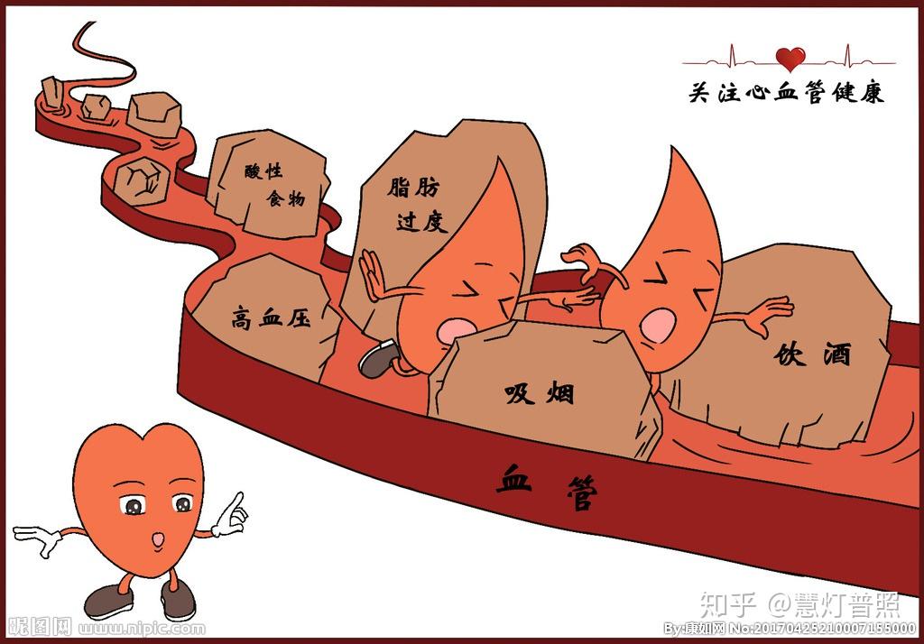 血管内的米汤动脉粥样硬化是怎么得的应该怎么治