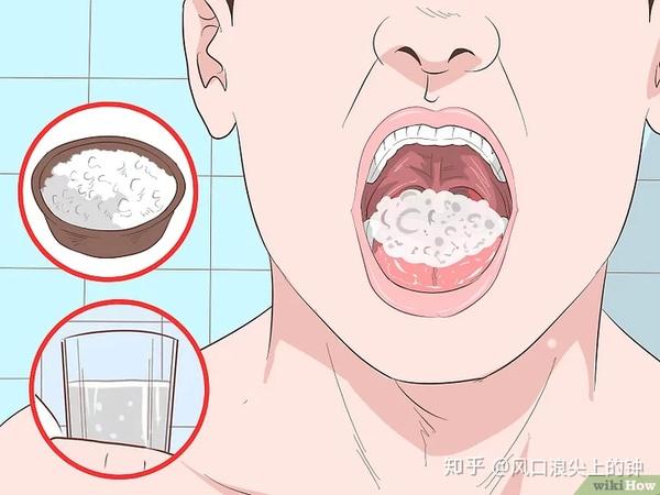 如何去除扁桃体结石 转 知乎 如何去除扁桃体结石 转 知乎