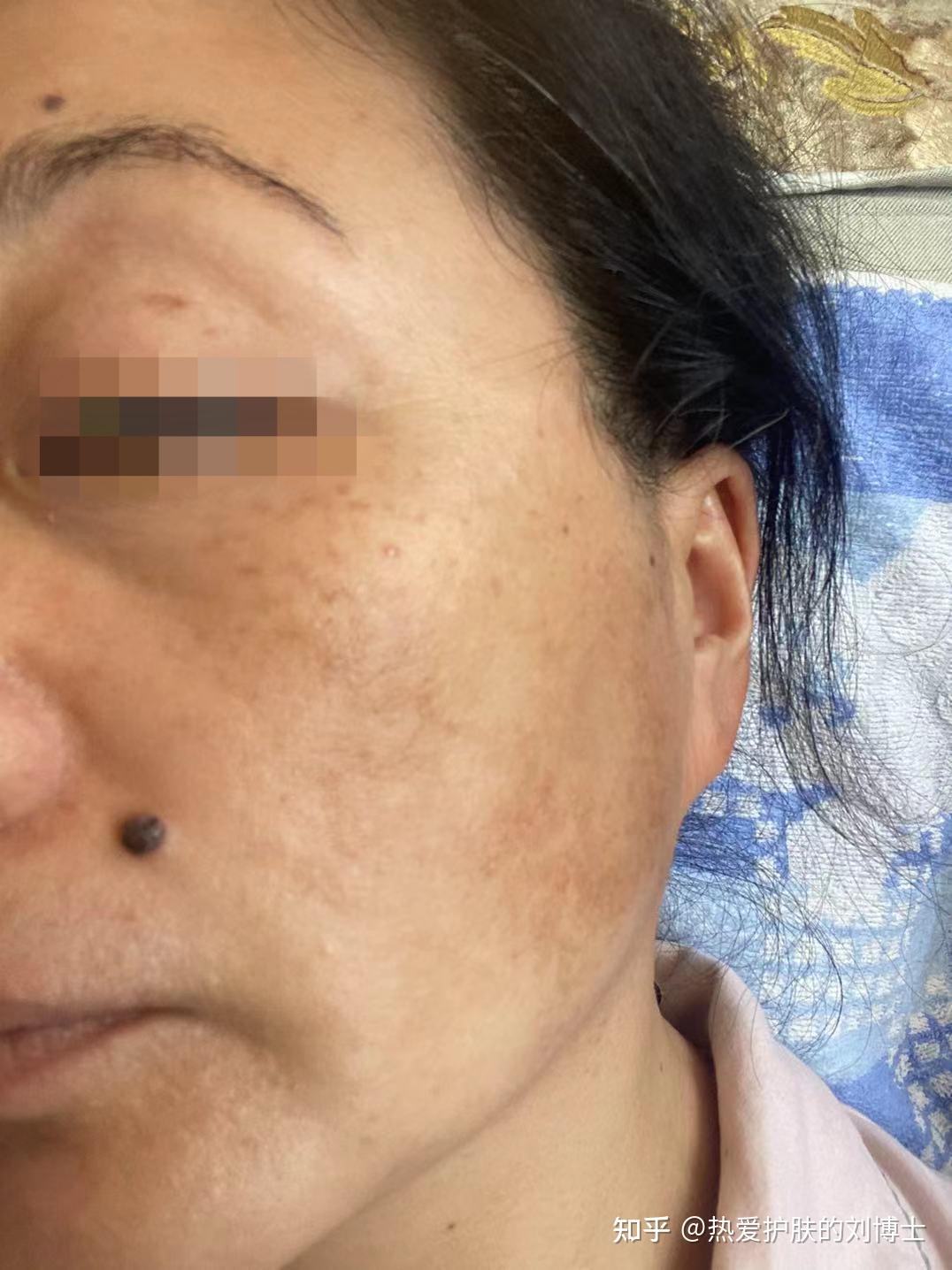 这位阿姨是我的一个邻居阿姨的同事,脸上长了黄褐斑,邻居阿姨介绍她来