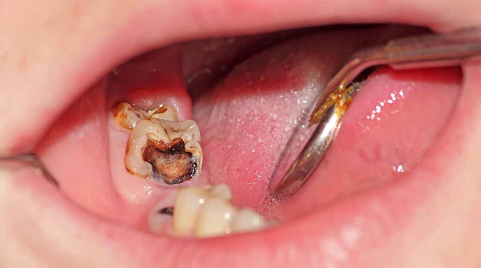 拔牙后感染了怎么处理?
