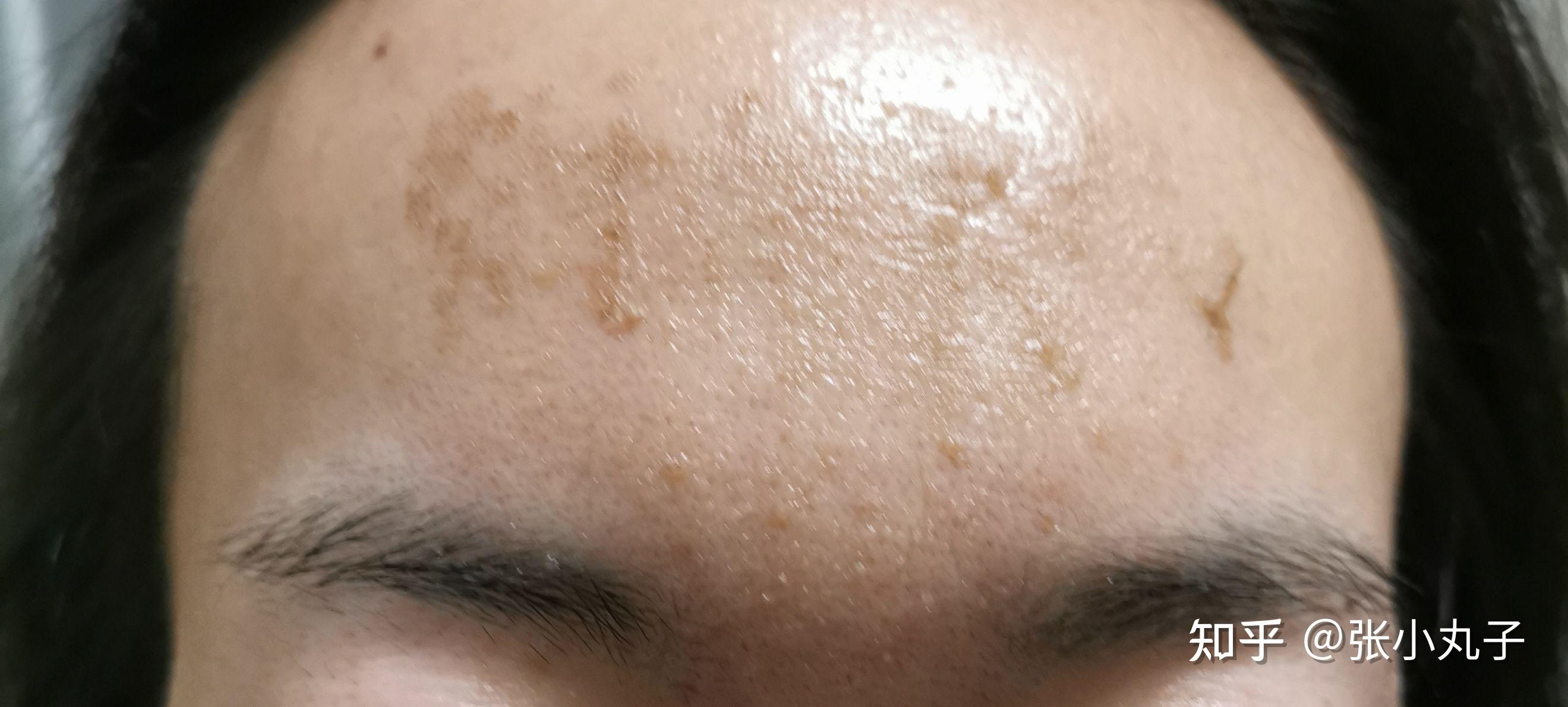 点阵激光收缩毛孔记录贴