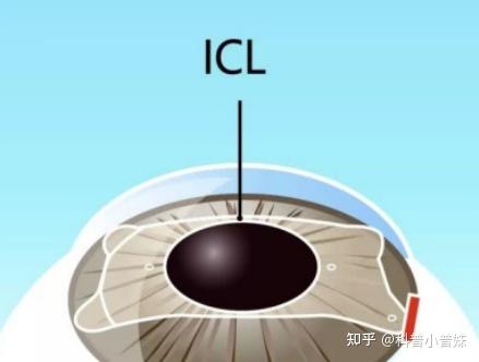 Icl晶体植入手术为什么贵 看后觉得贵的有道理 知乎