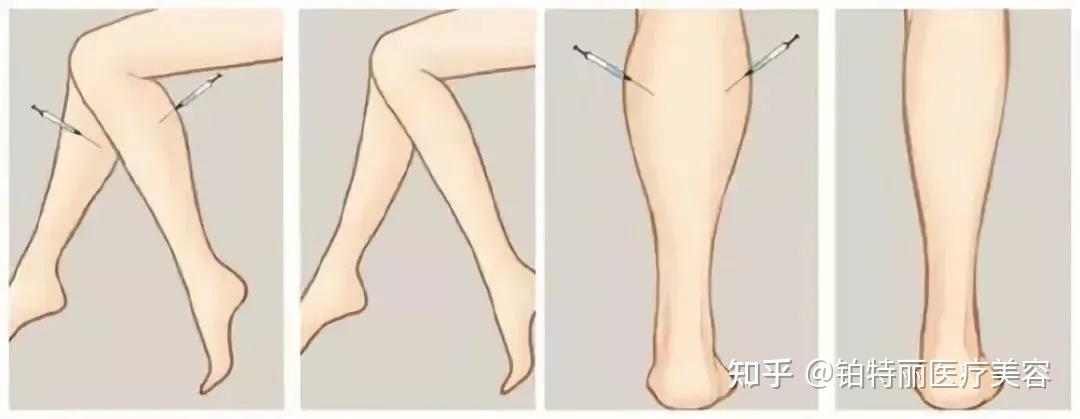 昆山瘦腿针真的能解决小腿肌肉问题
