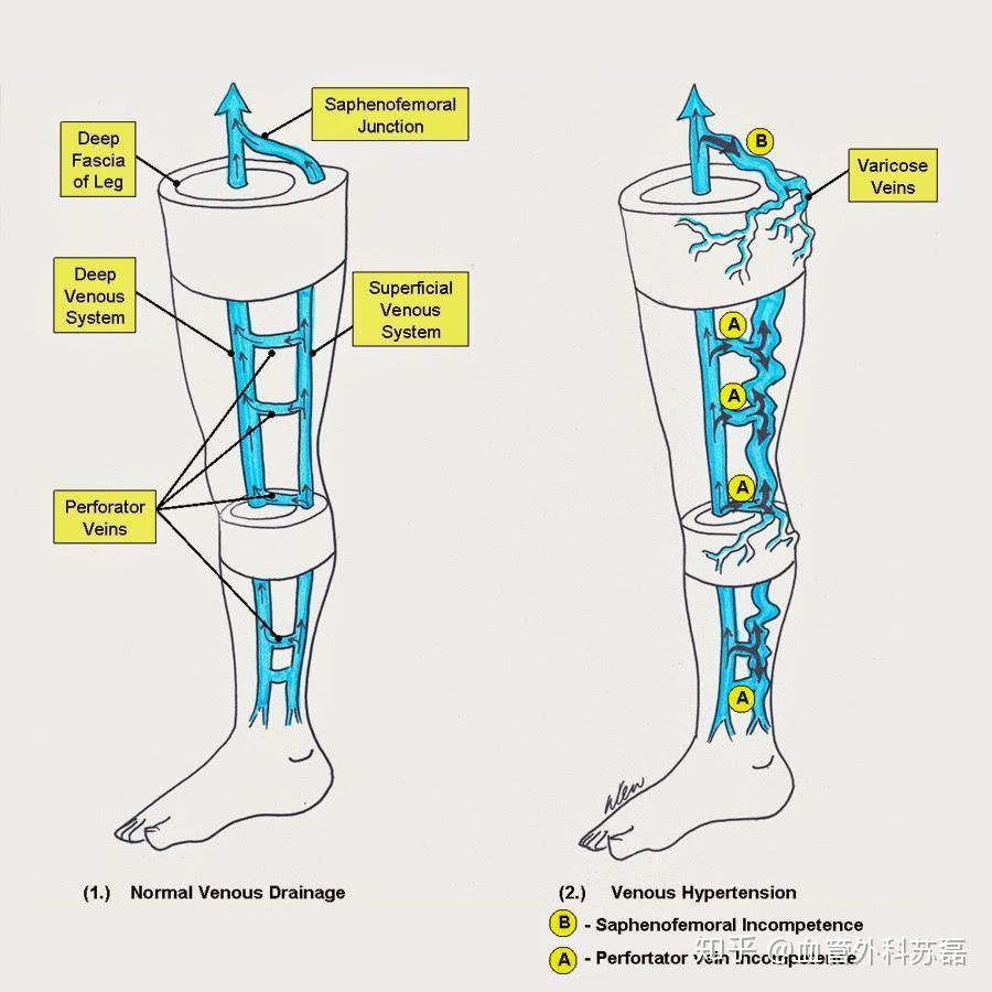 文献阅读穿静脉的概念及相应检查手段