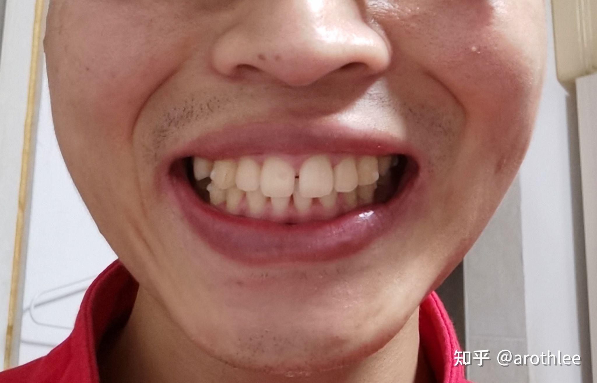 与第二幅牙套不同的是当初第二幅牙套刚戴上大板牙的力异常明显